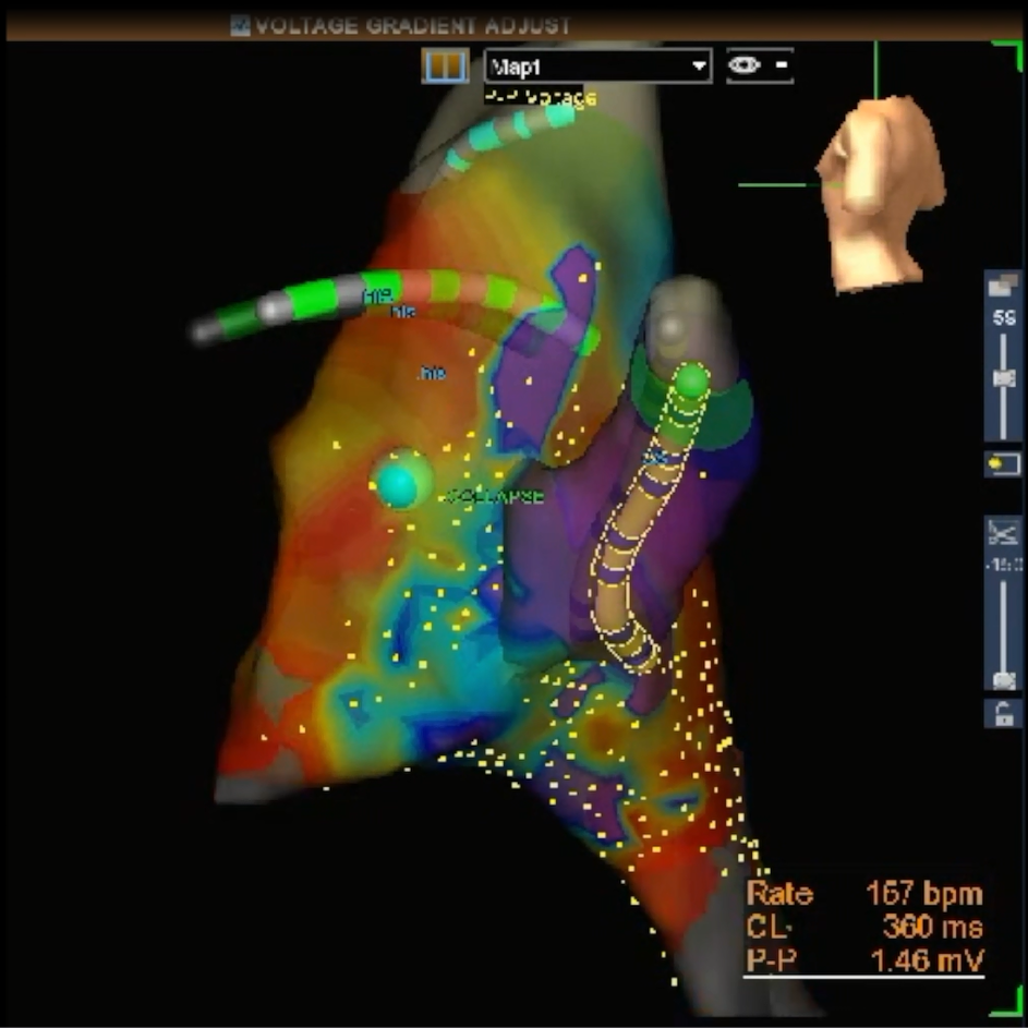 AVNRT – Randomized Clinical Trial for Treatment of Atrioventricular ...